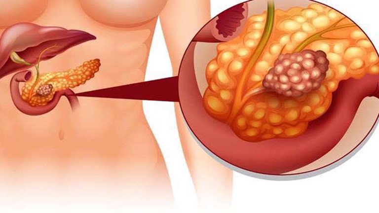 Khi men gan tăng cao cần phải làm gì?