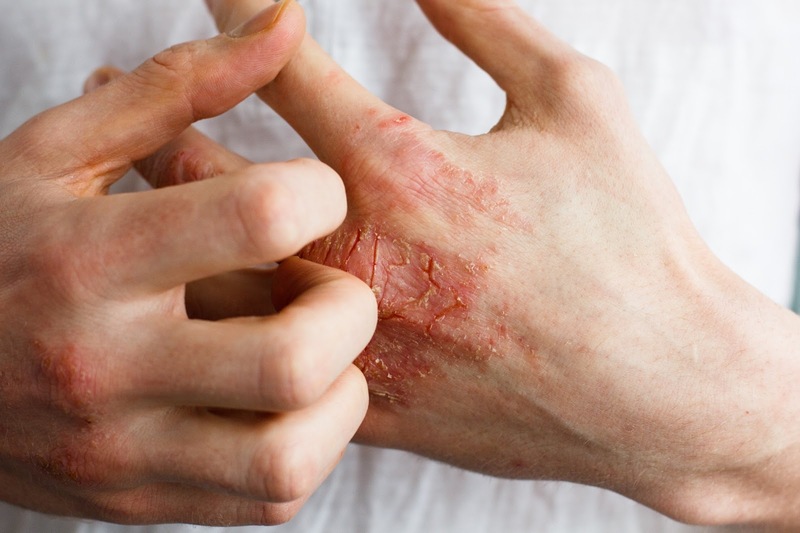 XÉT NGHIỆM CRP LÀ GÌ VÀ THƯỜNG ĐƯỢC CHỈ ĐỊNH KHI NÀO?
