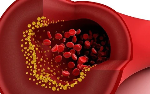 RỐI LOẠN CHUYỂN HÓA LIPID MÁU NÊN ĂN GÌ?
